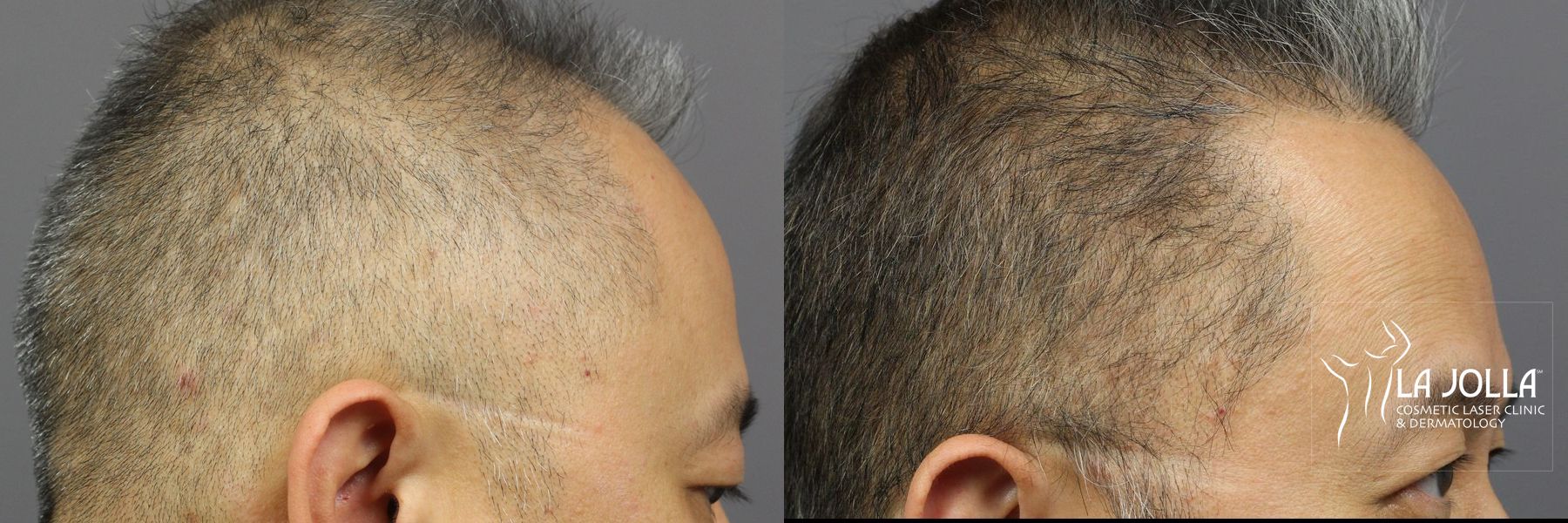 Before and after Hair Restoration case 36119 - Angle 3