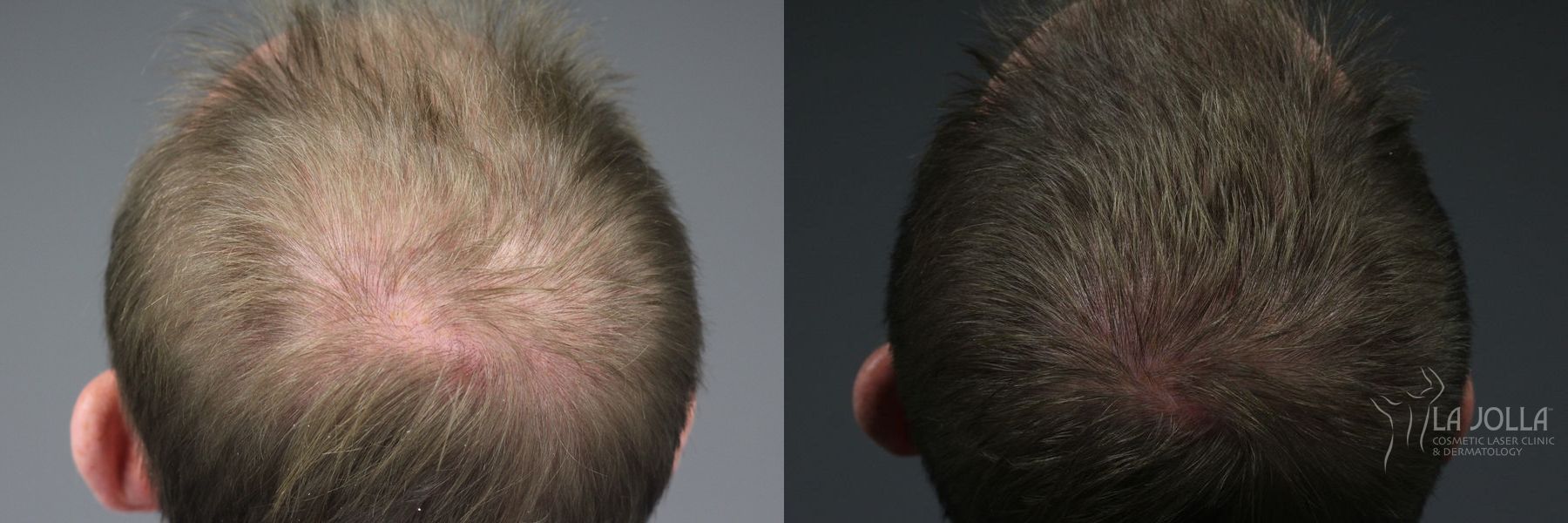 Before and after Hair Restoration case 36244 - Angle 2