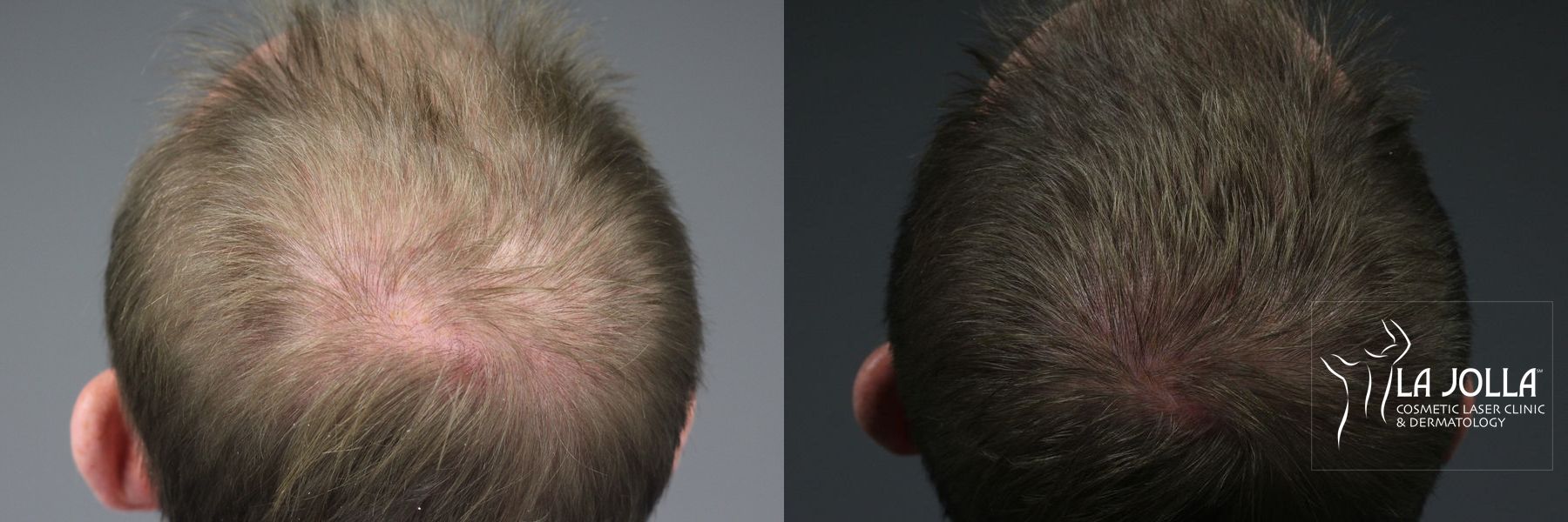 Before and after Hair Restoration case 36244 - Angle 2