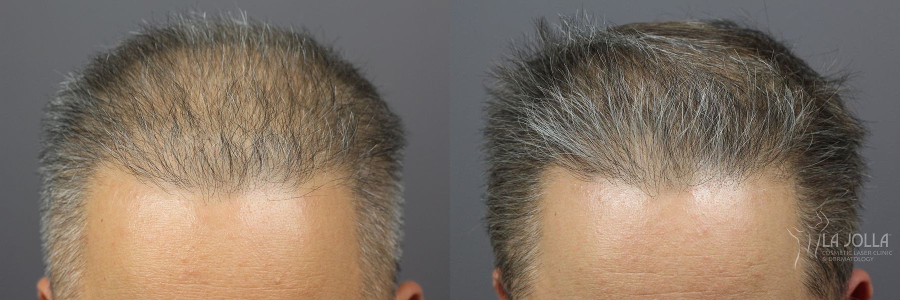 Before and after Hair Restoration case 36119