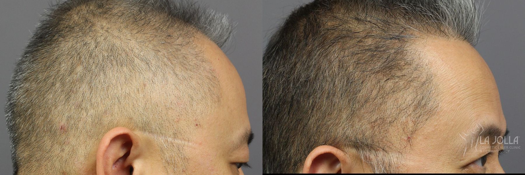 Before and after Hair Restoration case 36119 - Angle 3