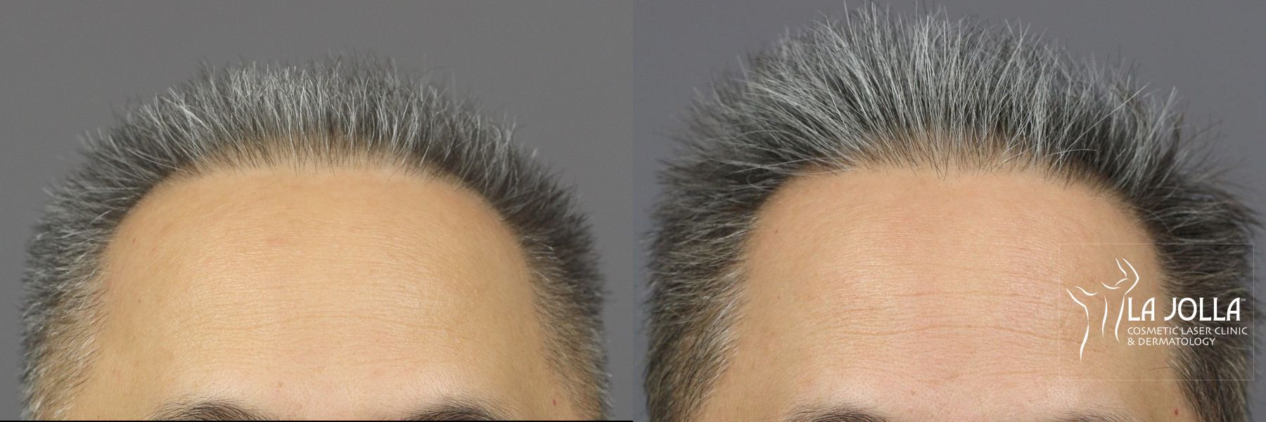 Before and after Hair Restoration case 36119 - Angle 2