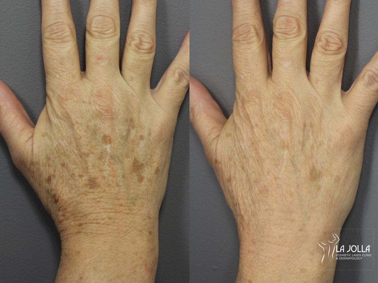 Before and after Hand Rejuvenation case 36094