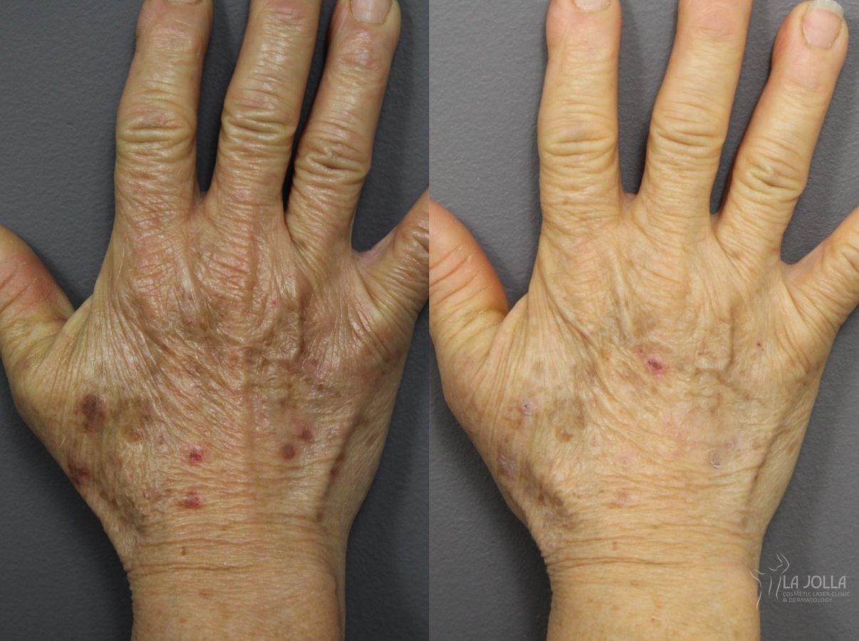 Before and after Hand Rejuvenation case 36138