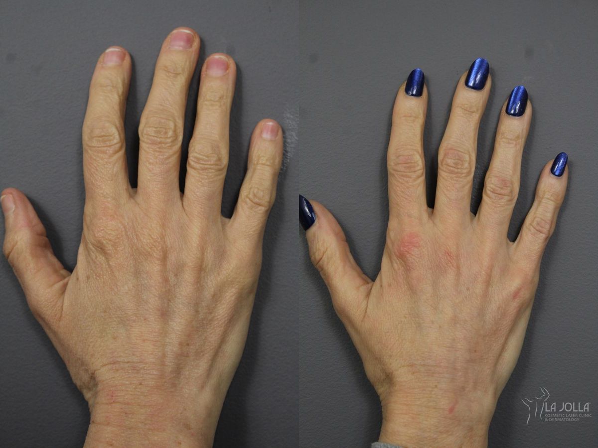 Before and after Hand Rejuvenation case 36076 - Angle 2