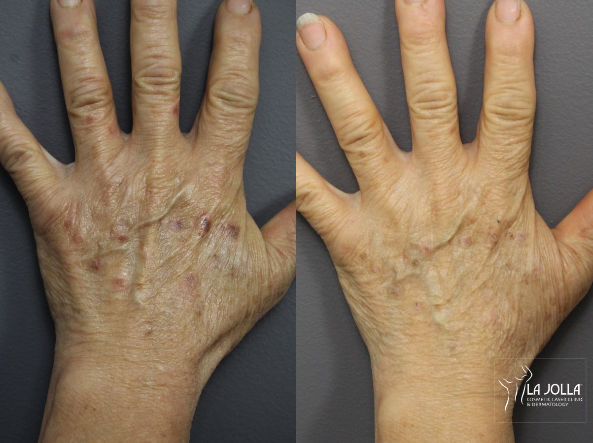 Before and after Hand Rejuvenation case 36138 - Angle 2
