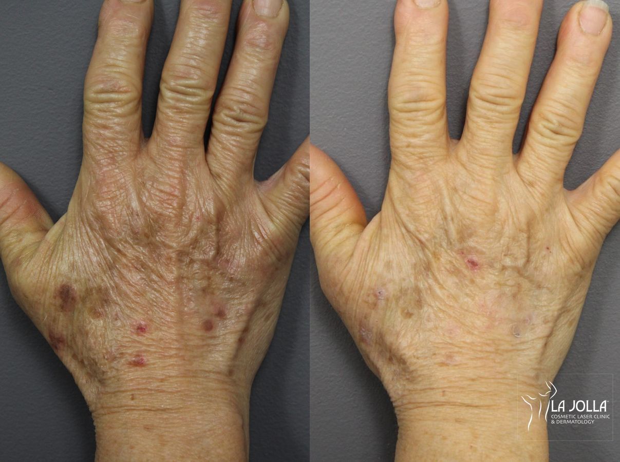 Before and after Hand Rejuvenation case 36138