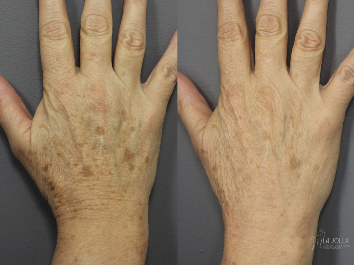 Before and after Hand Rejuvenation case 36094