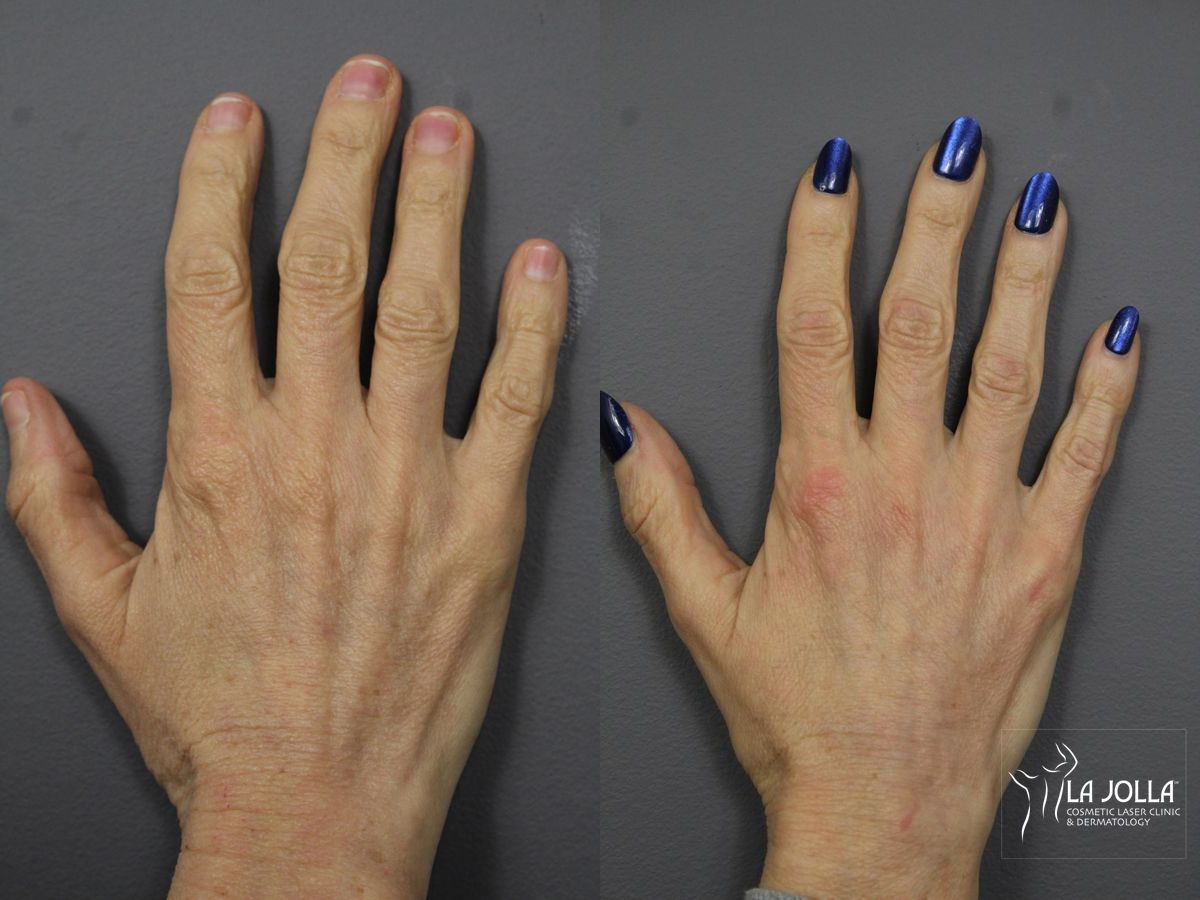 Before and after Hand Rejuvenation case 36076 - Angle 2