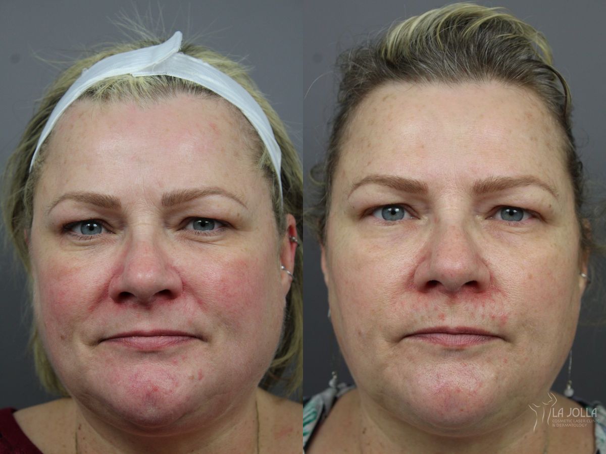 Before and after IPL case 36440