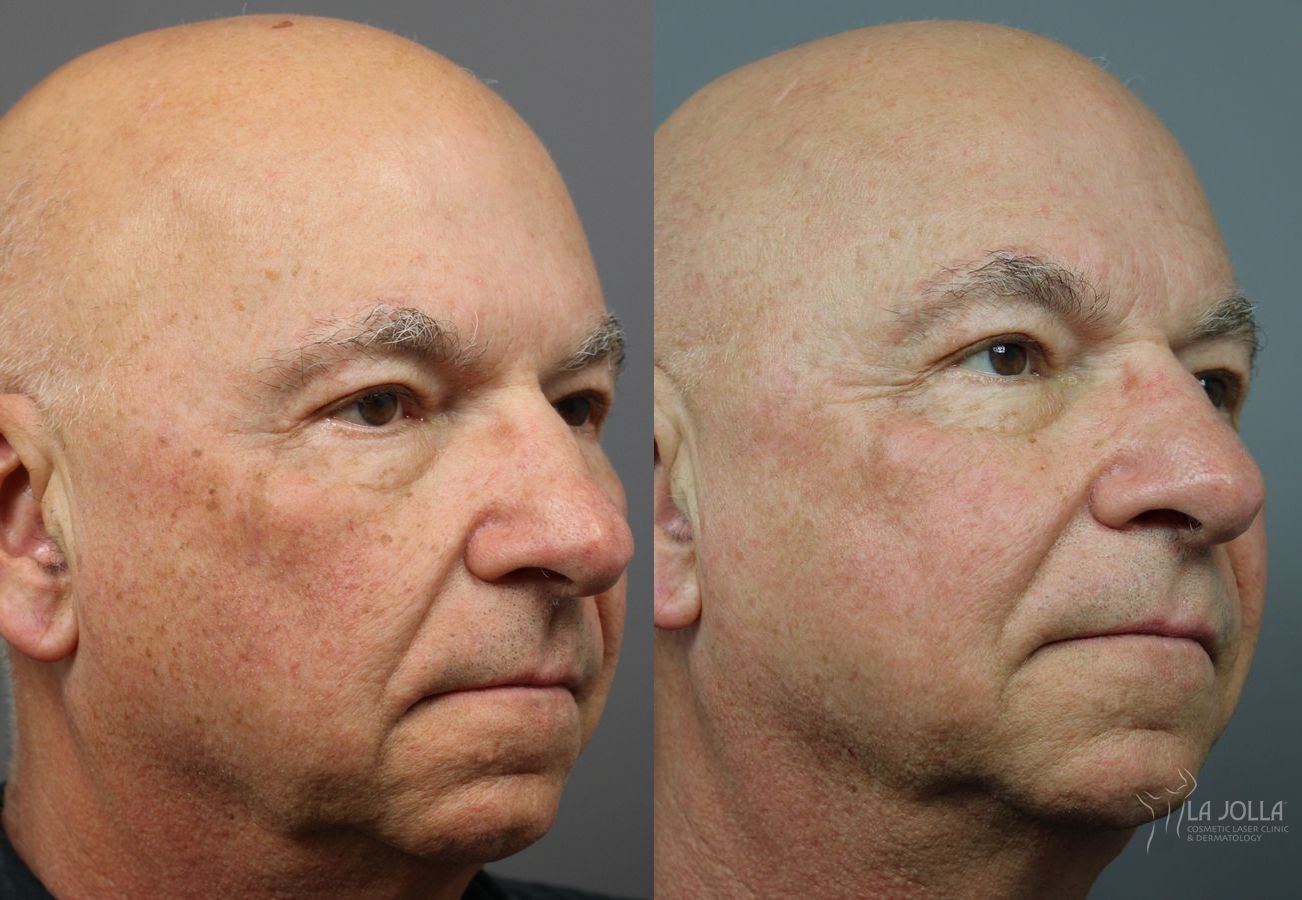 Before and after IPL case 36394