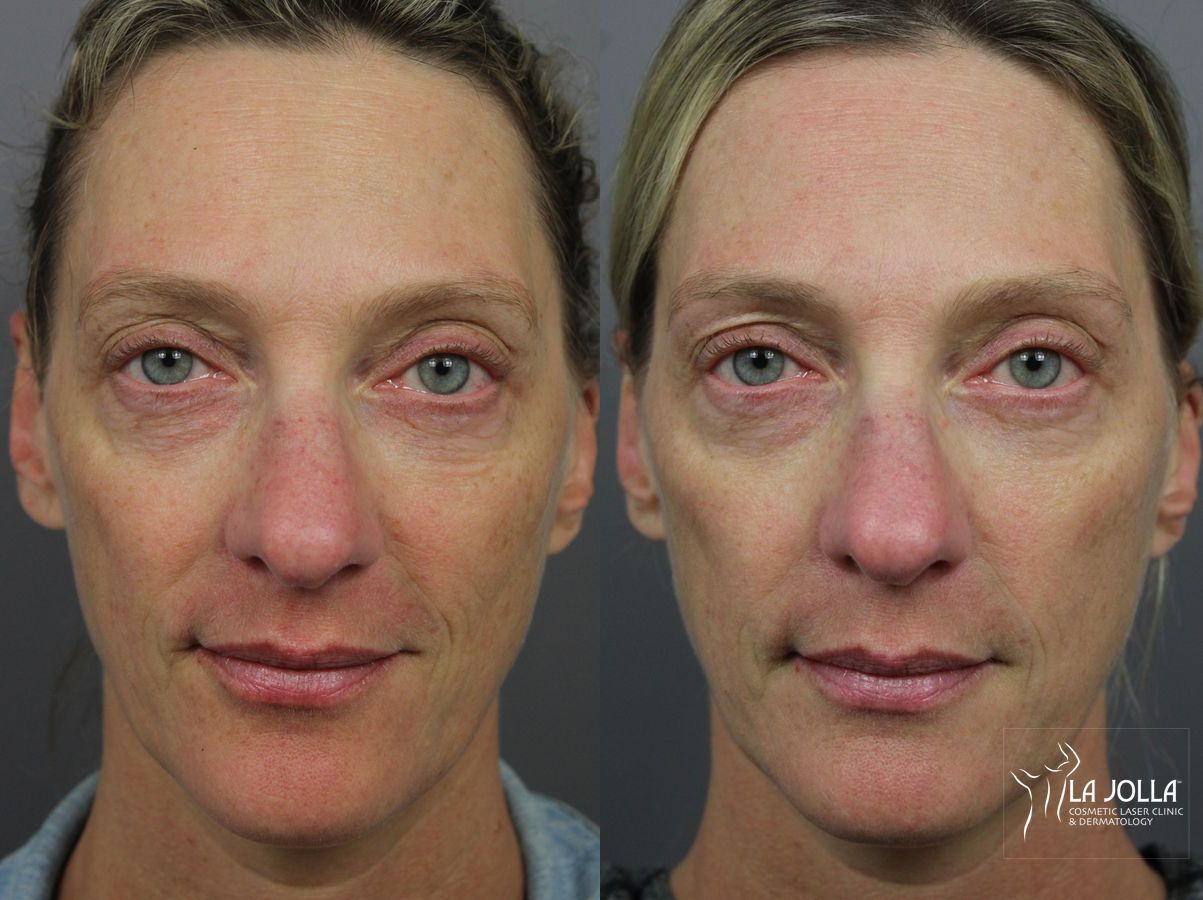 Before and after IPL case 36431