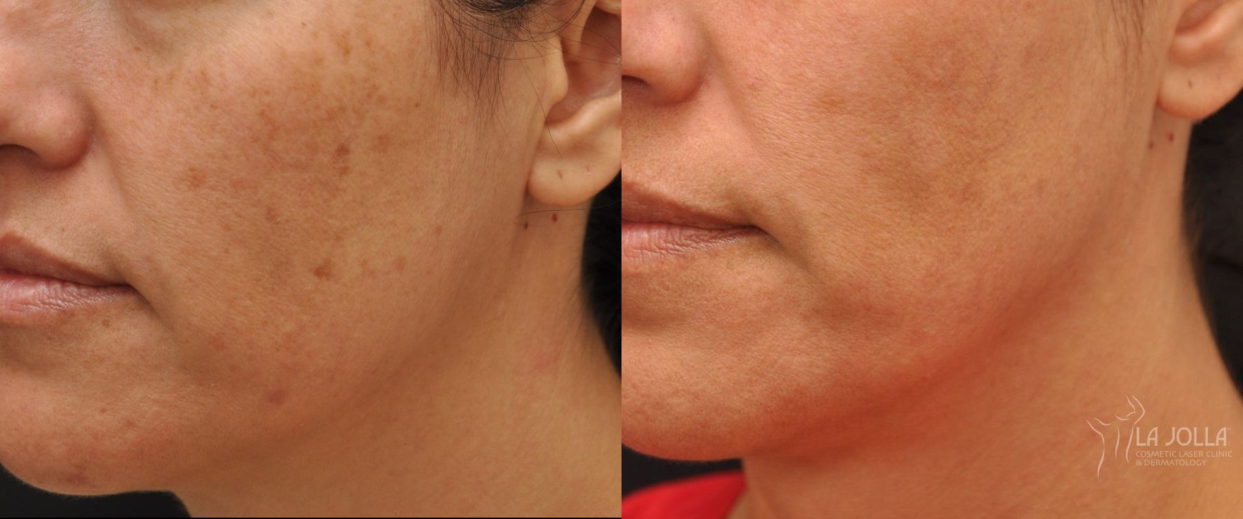Before and after IPL case 36437
