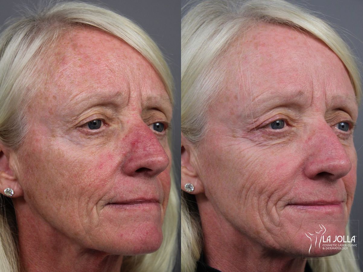 Before and after IPL case 36444 - Angle 2