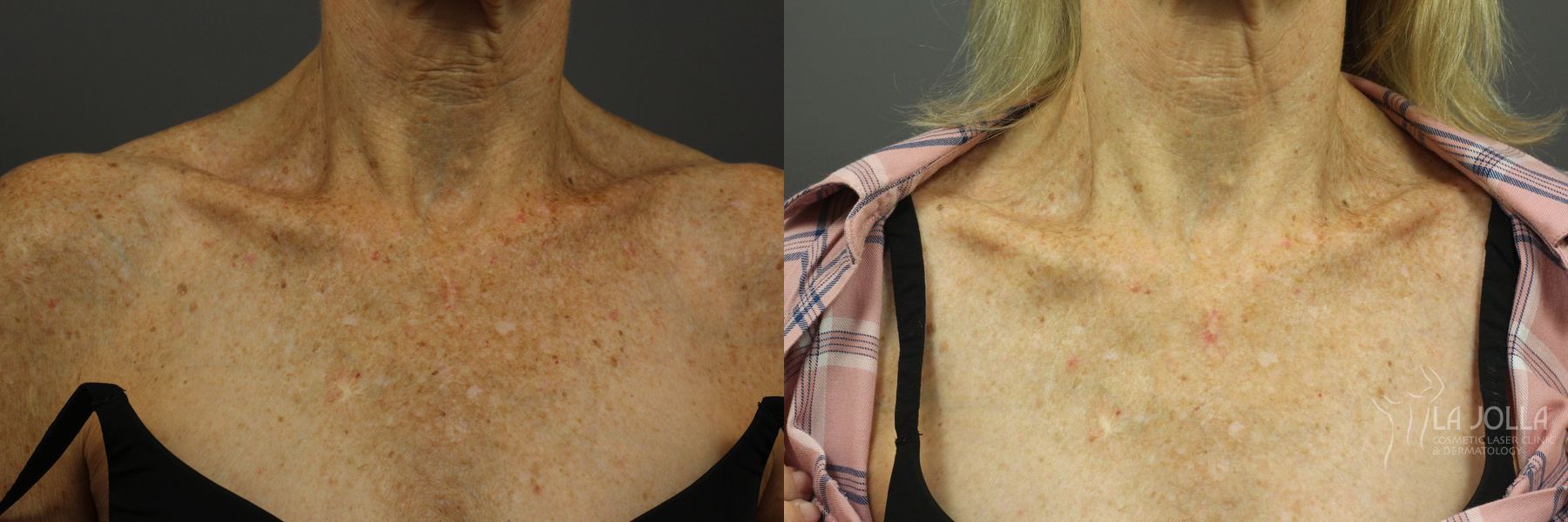 Before and after IPL case 36392