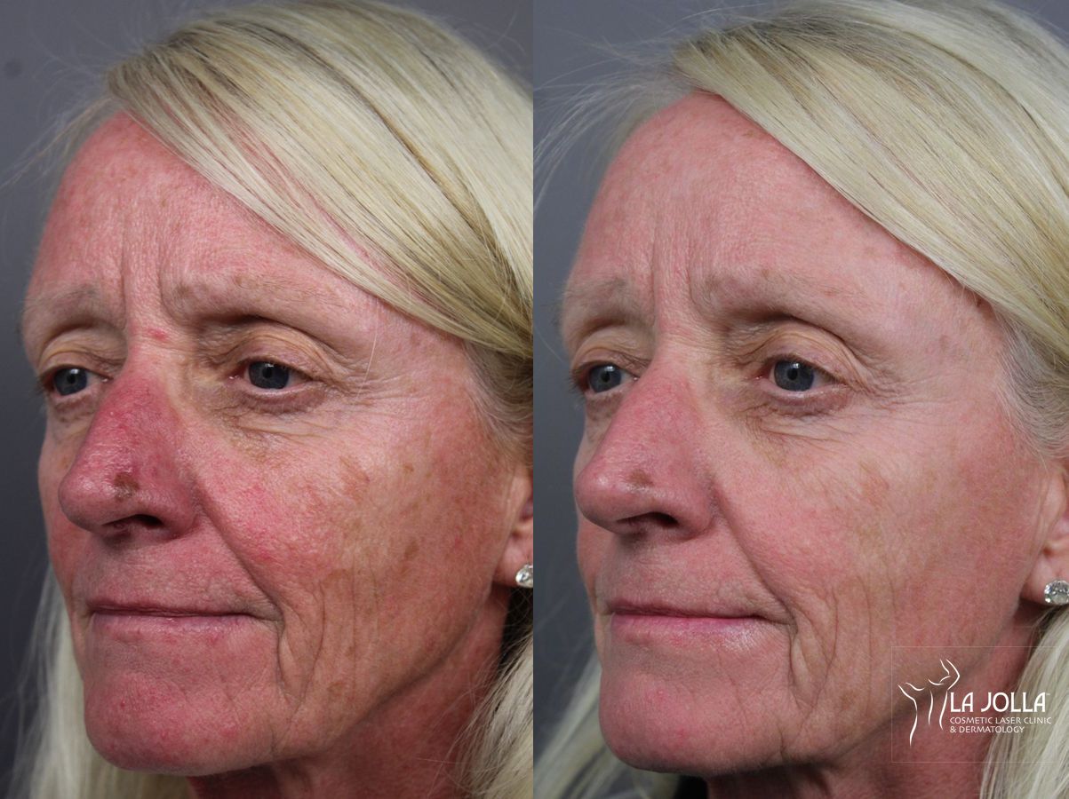 Before and after IPL case 36444