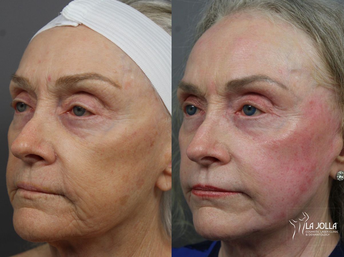 Before and after IPL case 36442 - Angle 2