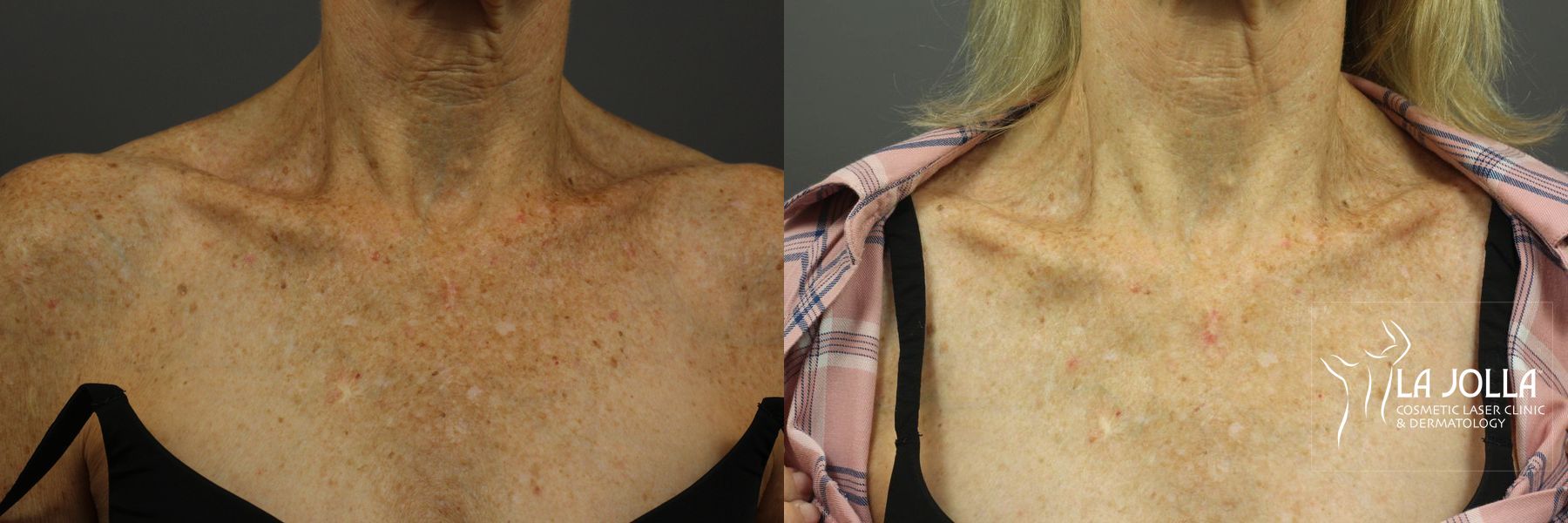 Before and after IPL case 36392