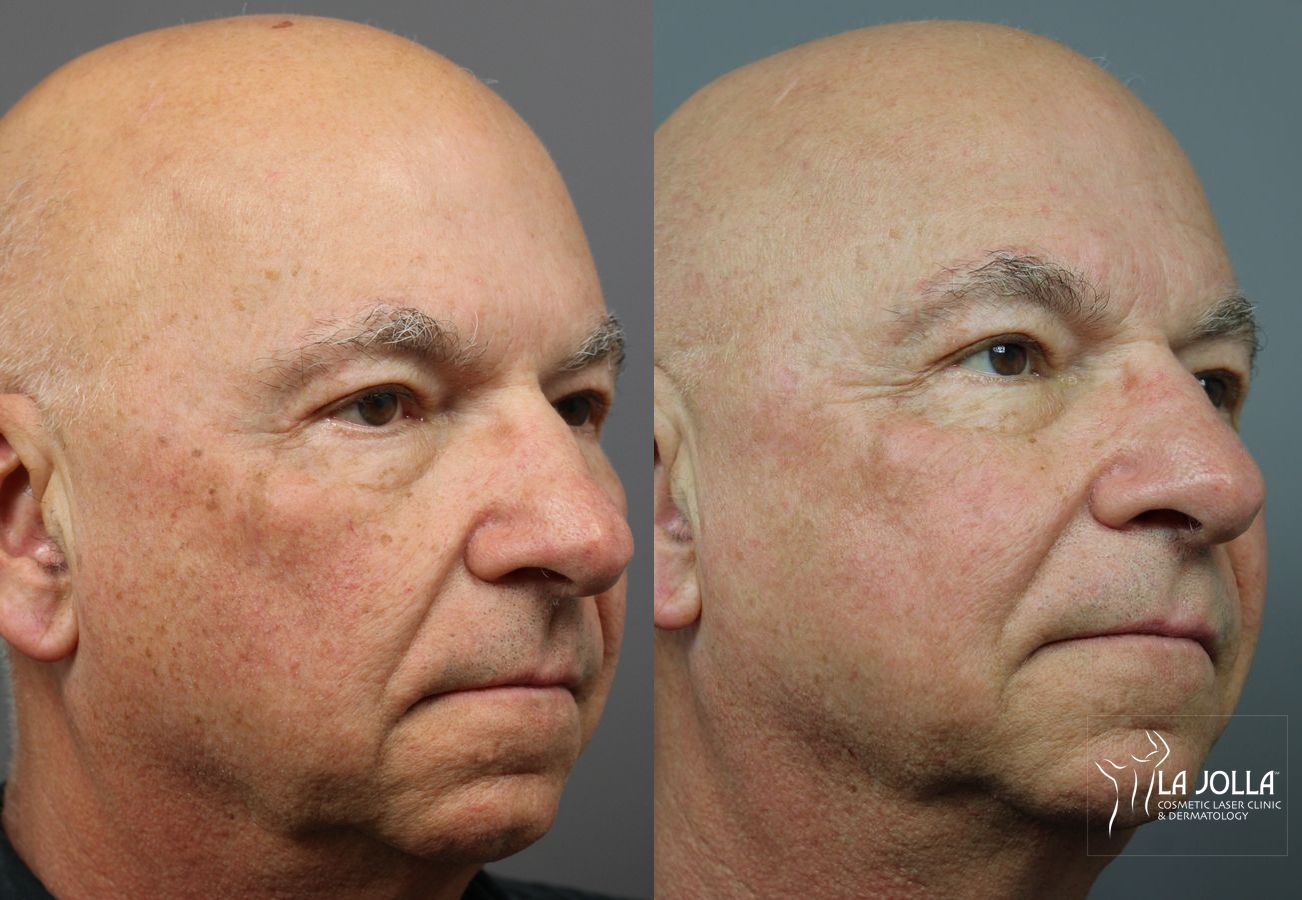 Before and after IPL case 36394