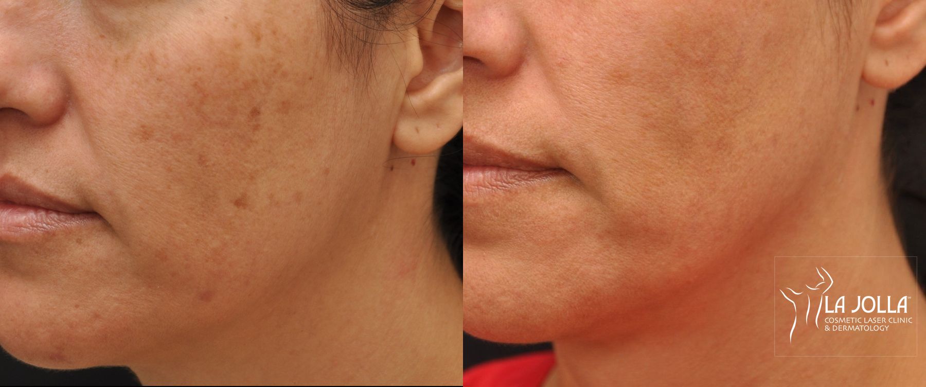 Before and after IPL case 36437