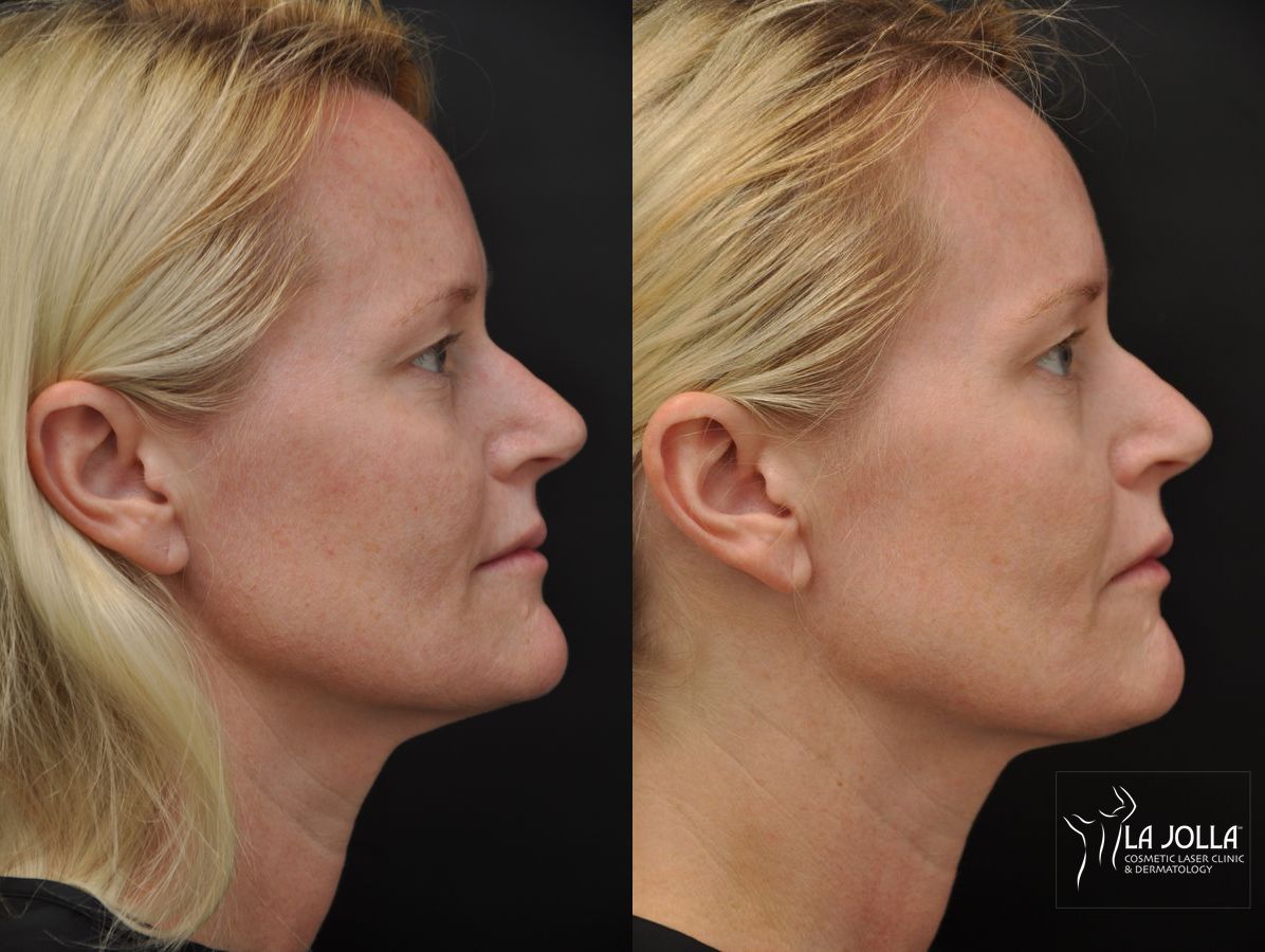 Before and after IPL case 36436