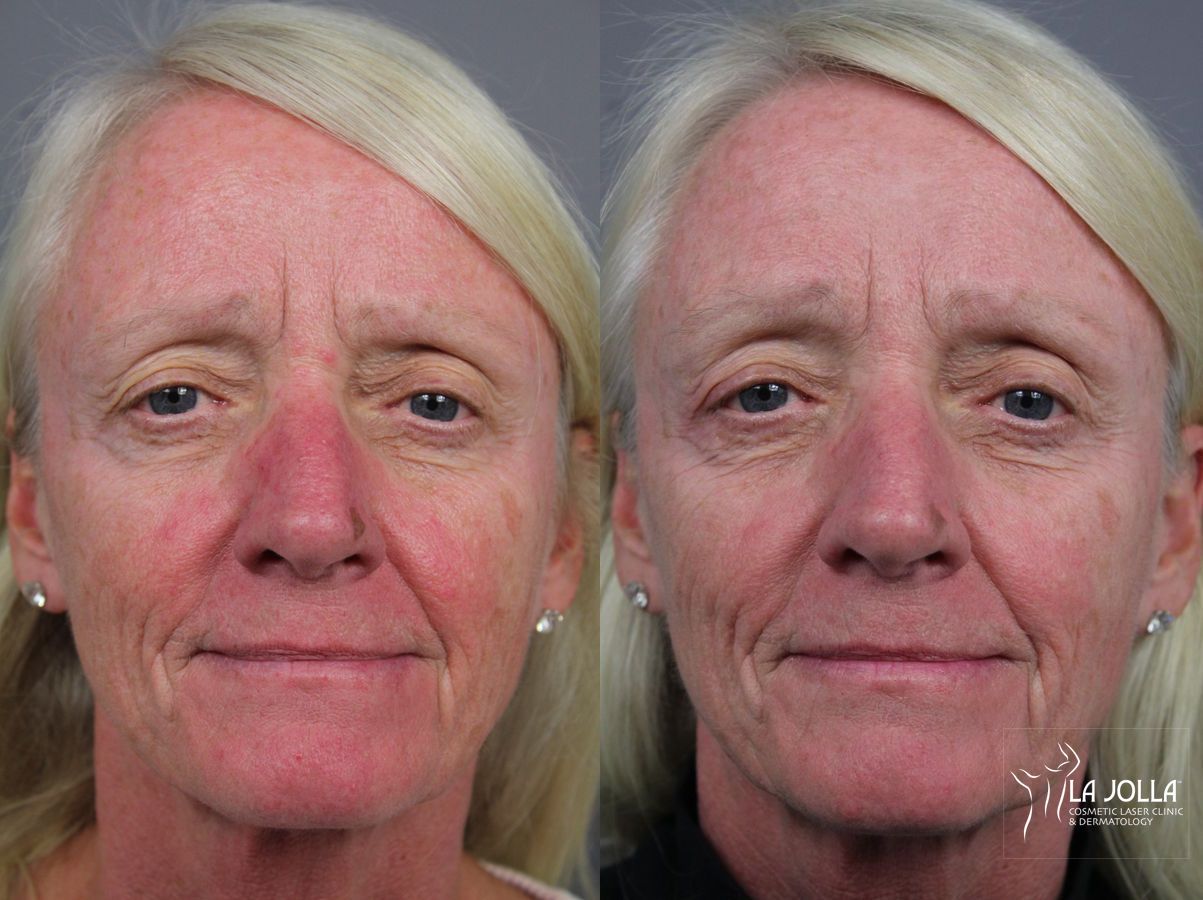 Before and after IPL case 36444 - Angle 3