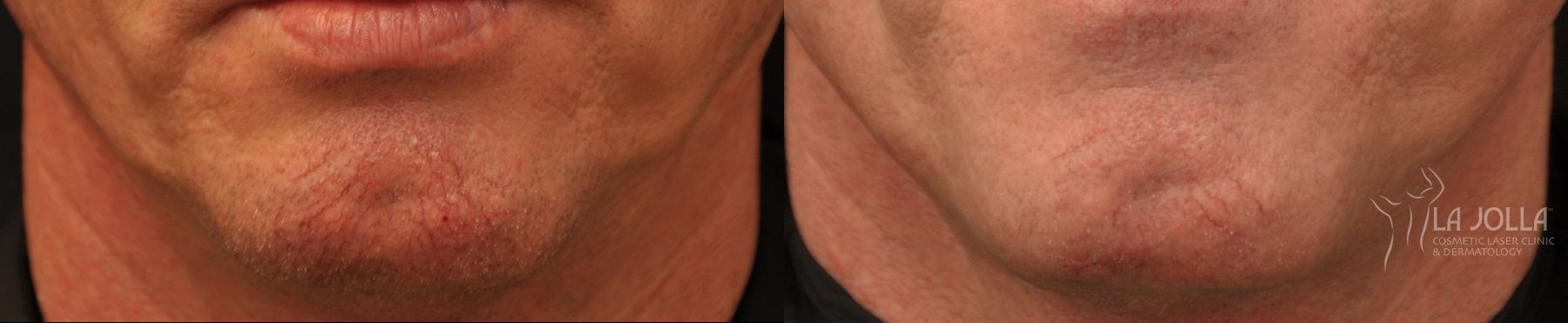 Before and after IPL case 36426