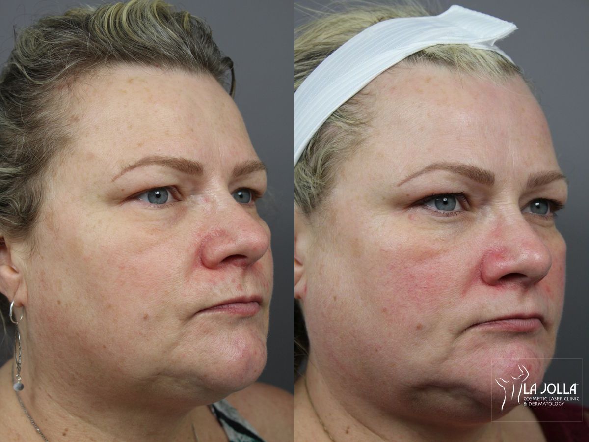 Before and after IPL case 36398 - Angle 2