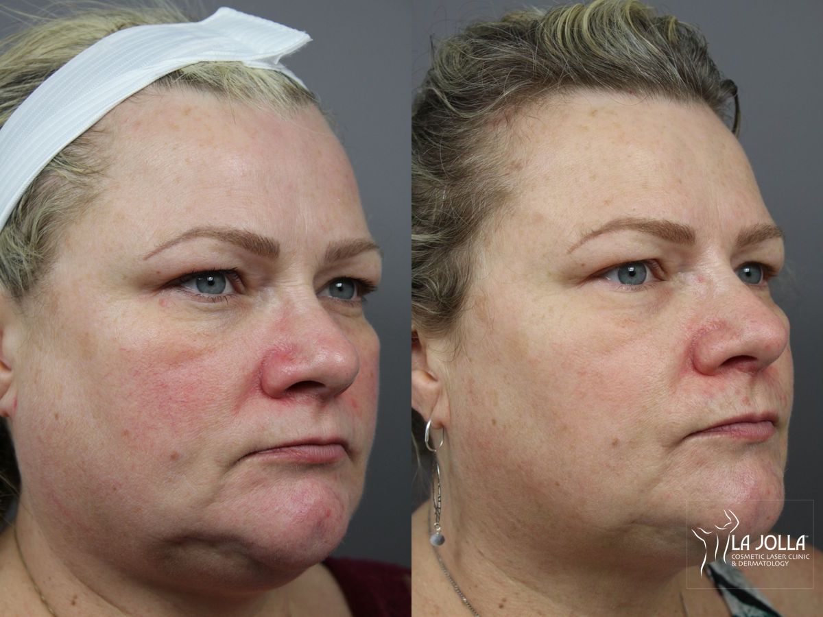 Before and after IPL case 36440 - Angle 2