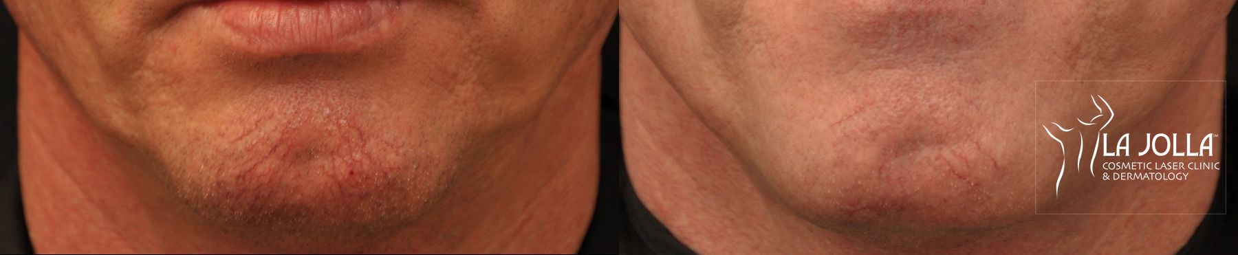 Before and after IPL case 36426