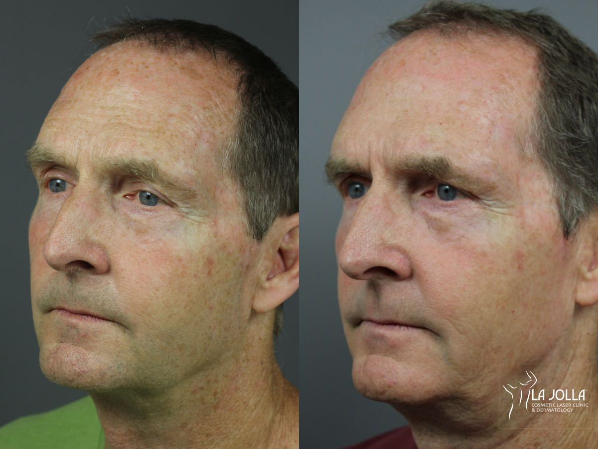 Before and after IPL case 36390