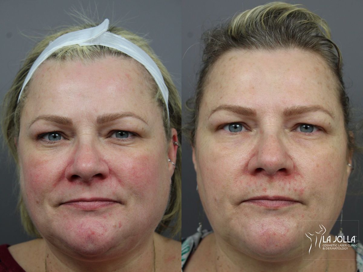 Before and after IPL case 36440