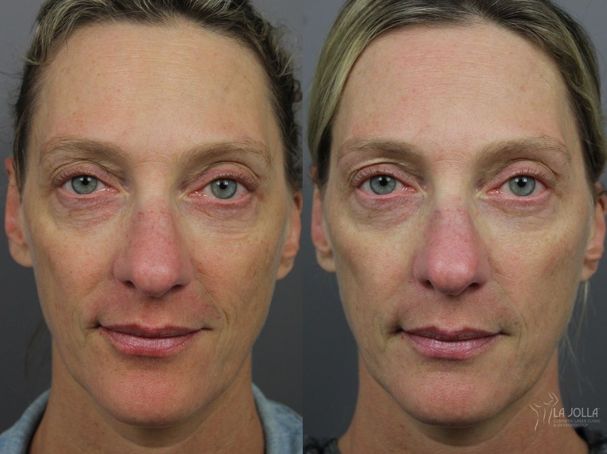 Before and after IPL case 36431