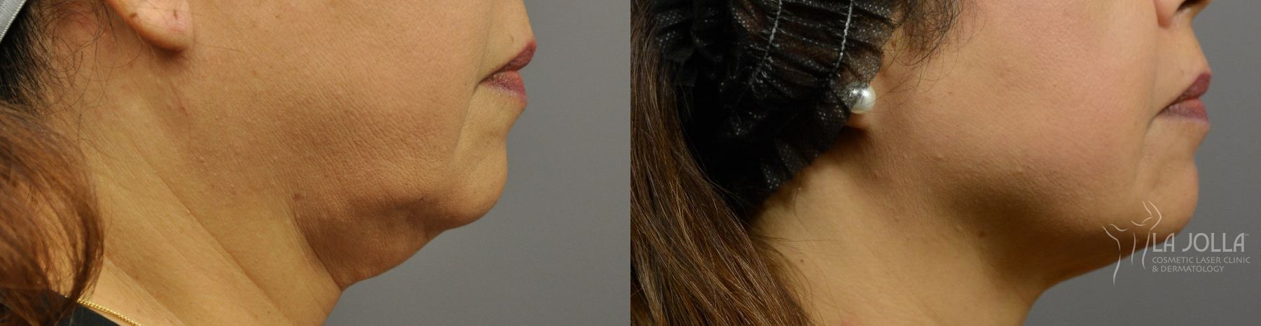 Before and after Kybella case 36132