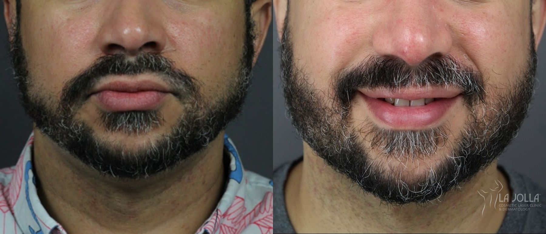 Before and after Kybella case 36429