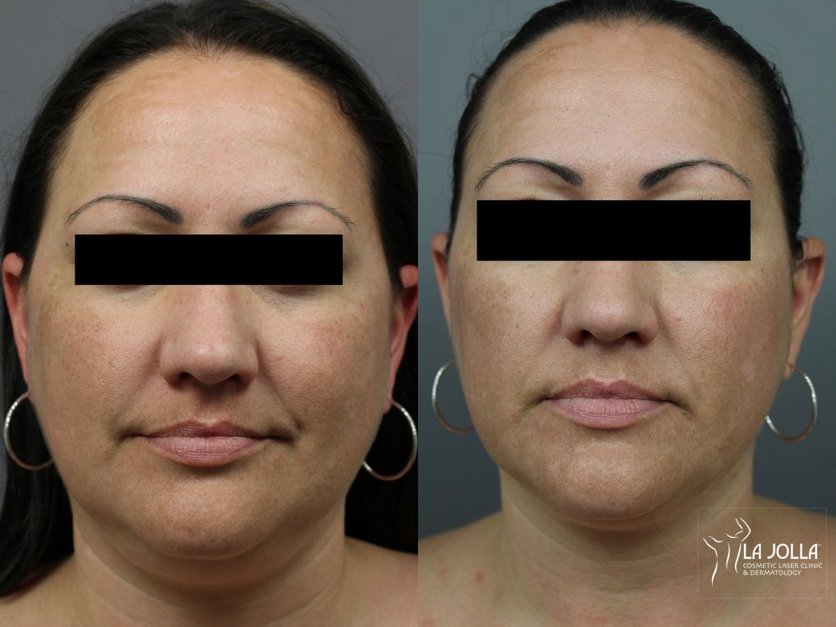 Before and after Kybella case 36221 - Angle 2