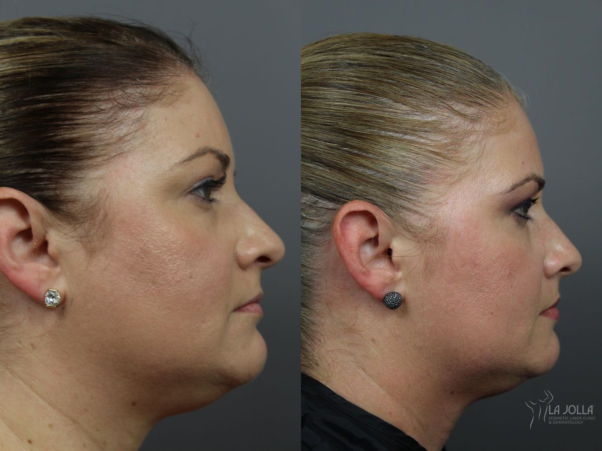 Before and after Kybella case 36090