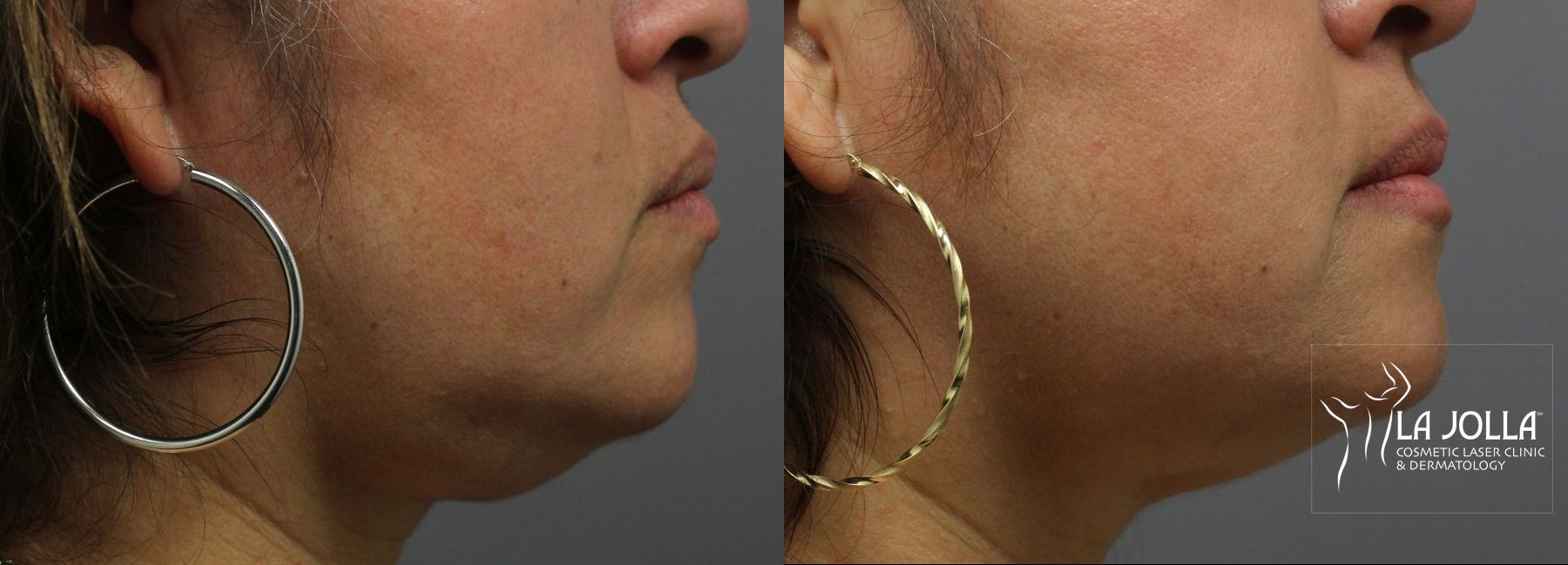 Before and after Kybella case 36171