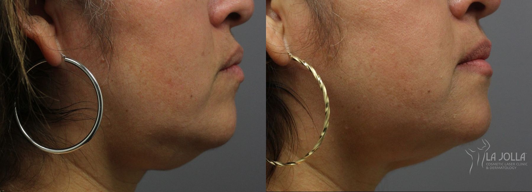 Before and after Kybella case 36171