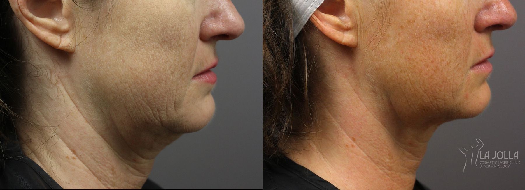 Before and after Kybella case 36193