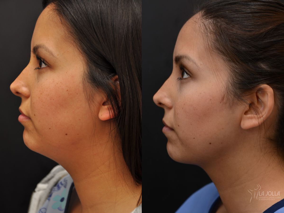 Before and after Kybella case 36153