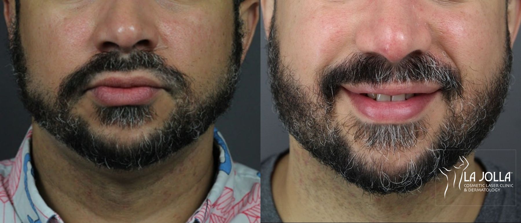 Before and after Kybella case 36429