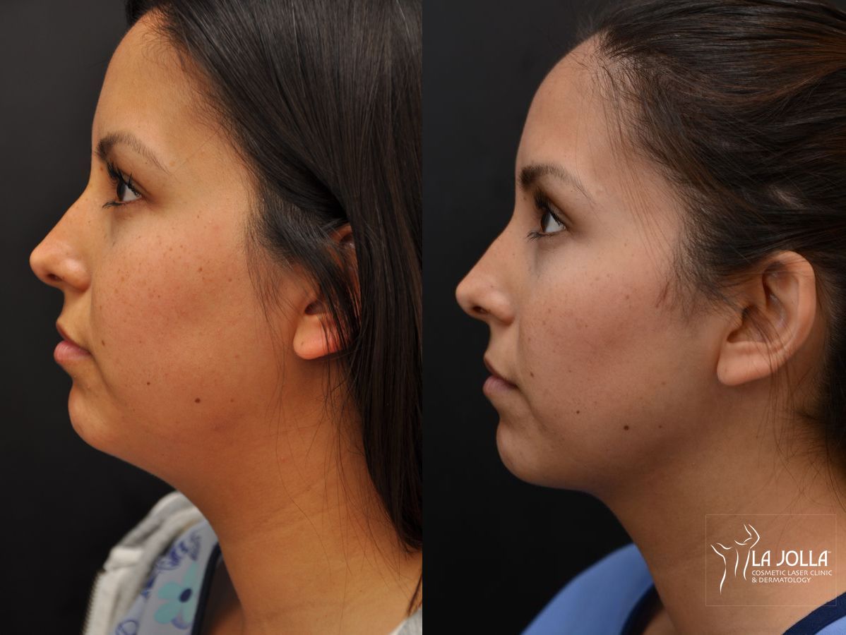 Before and after Kybella case 36153