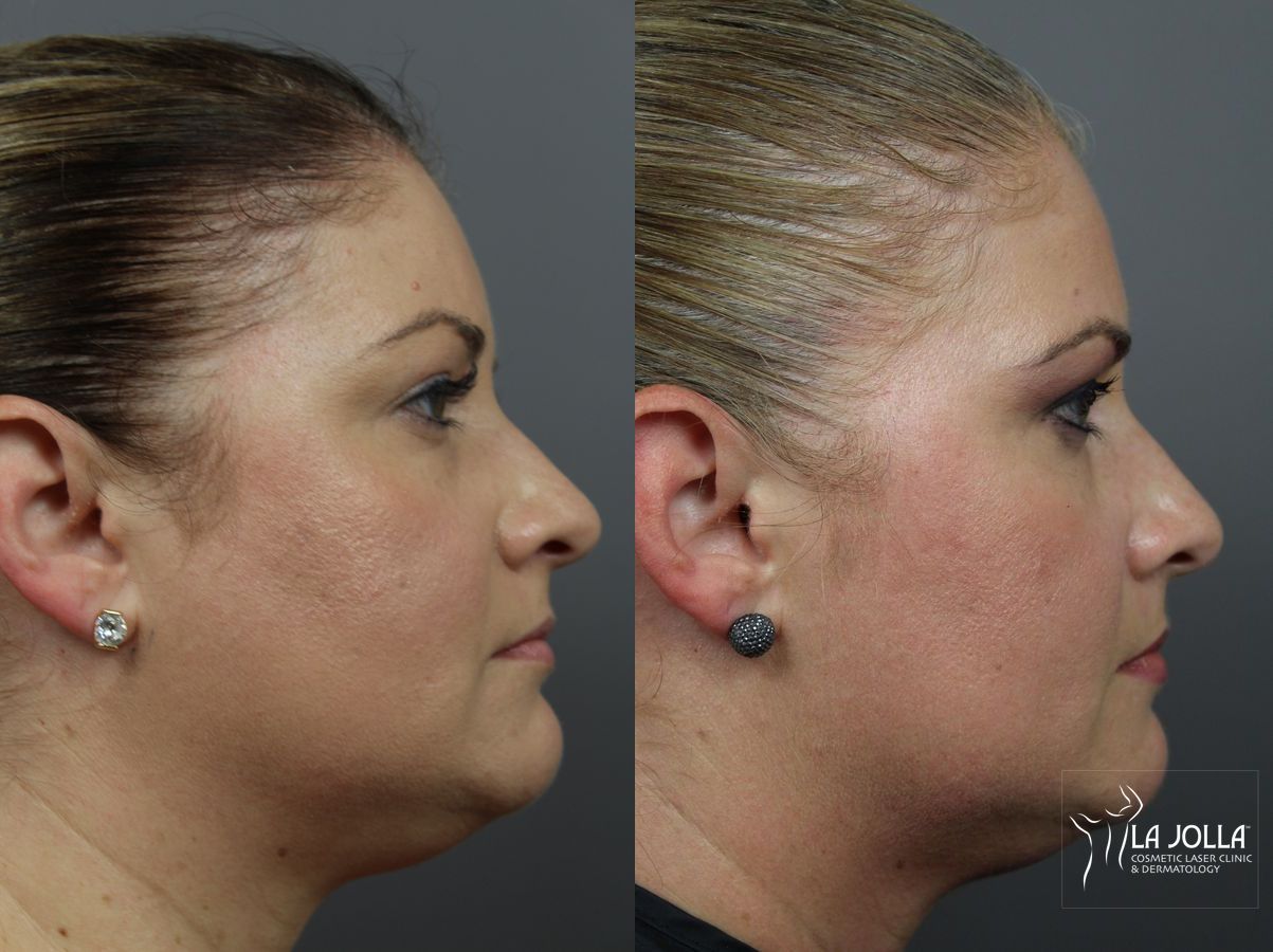 Before and after Kybella case 36070