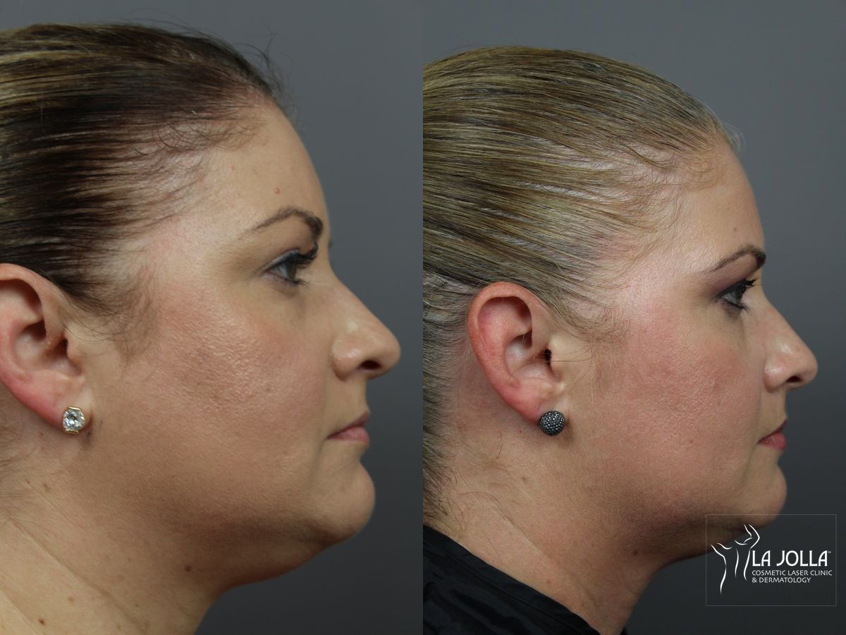 Before and after Kybella case 36090