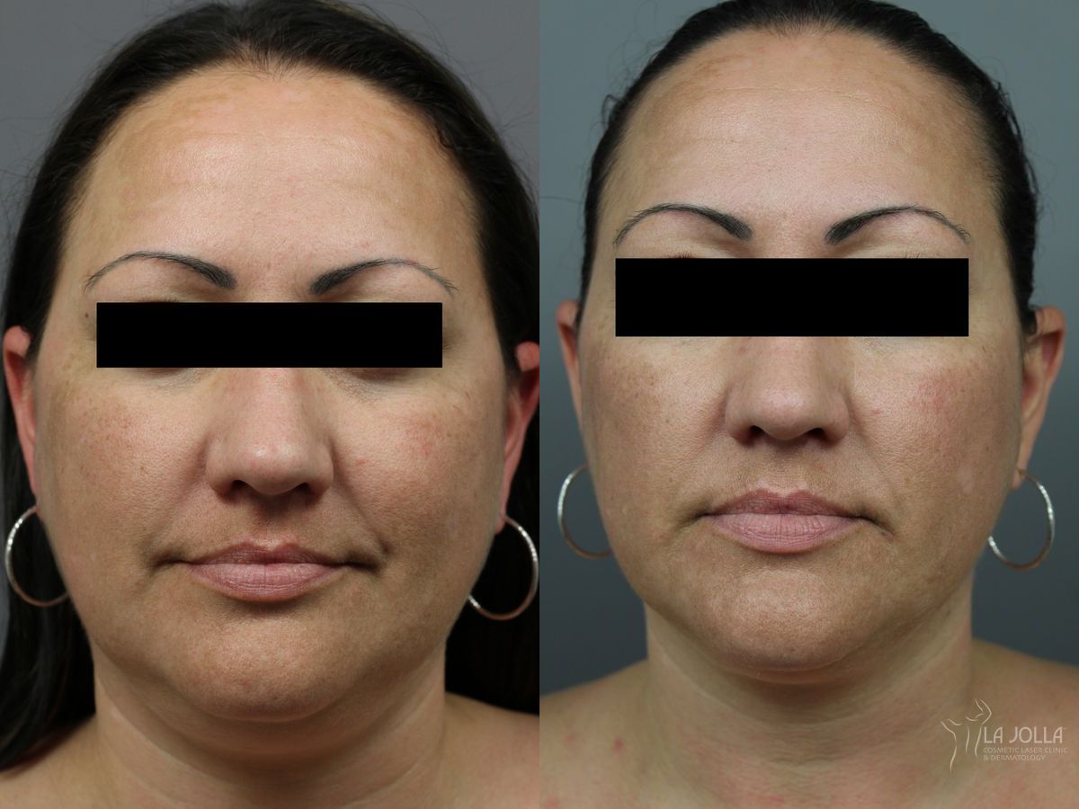 Before and after Kybella case 36221 - Angle 2