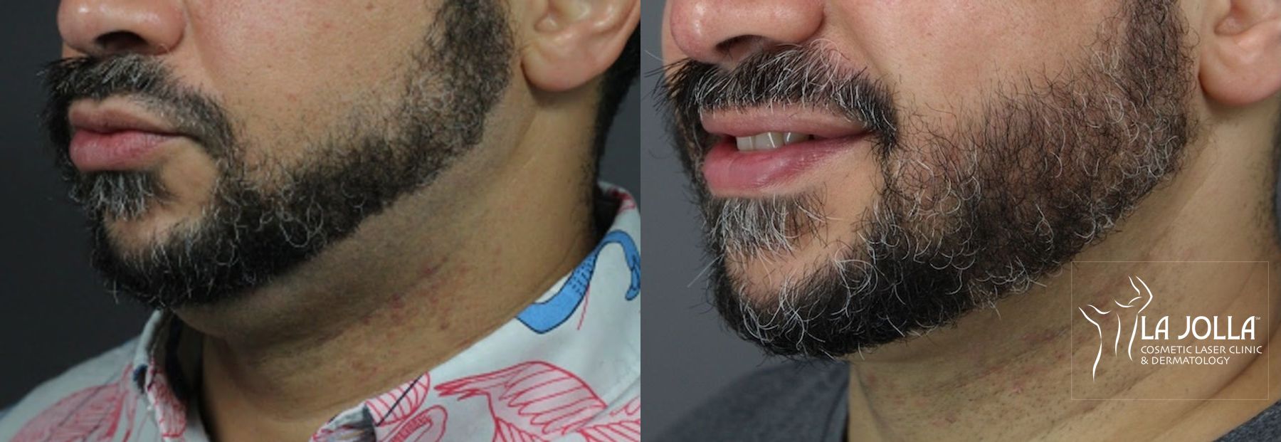 Before and after Kybella case 36429 - Angle 2