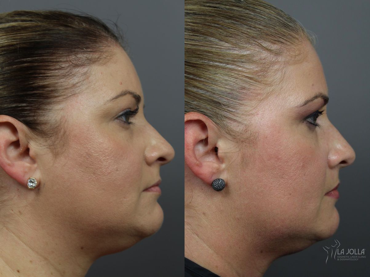Before and after Kybella case 36070