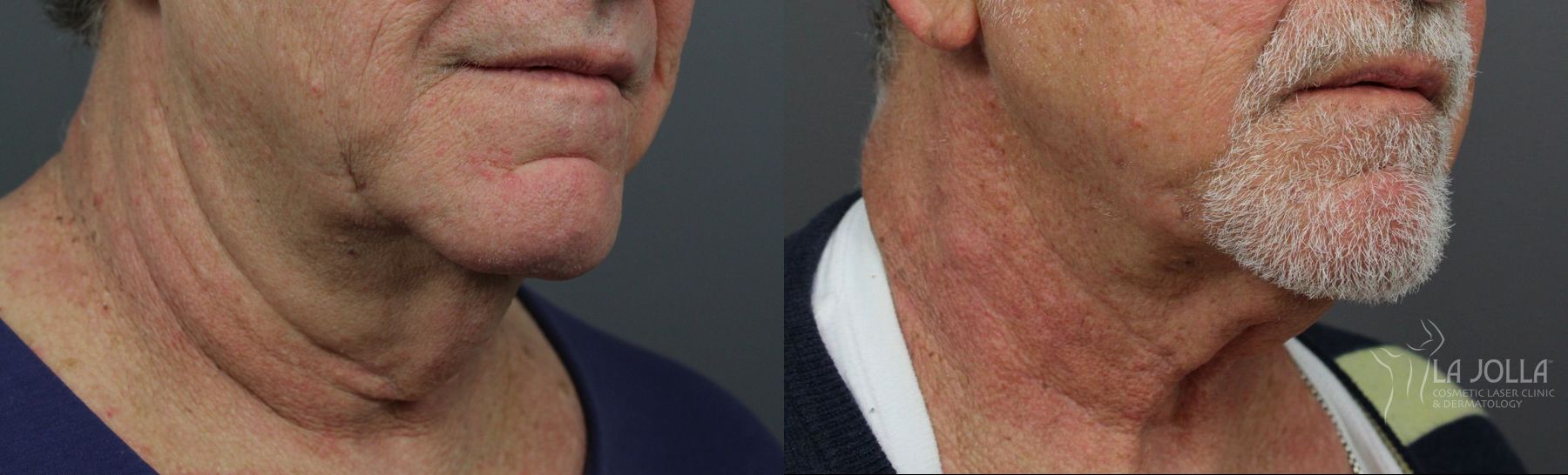Before and after Laser Coring (Poke A Dot Lift®) case 36194