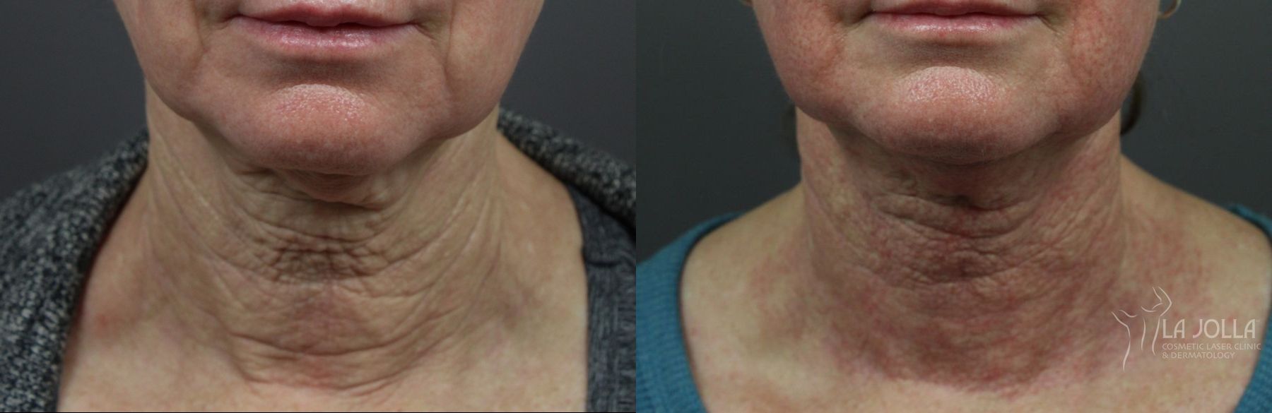 Before and after Laser Coring (Poke A Dot Lift®) case 36157 - Angle 2